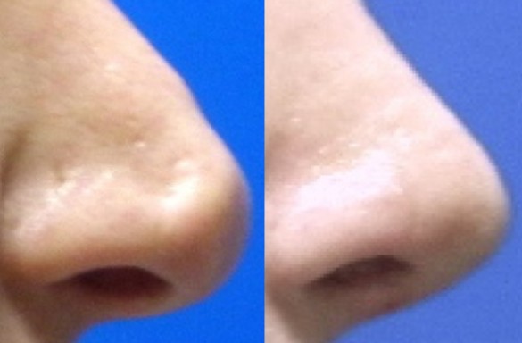 Rhinoplastika zavřenou technikou