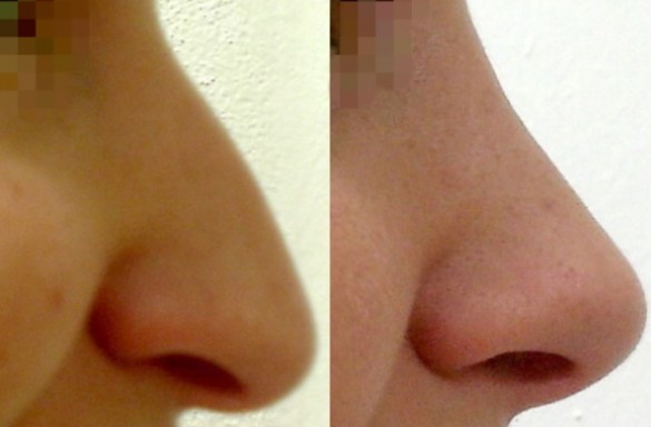 Rhinoplastika otevřenou technikou