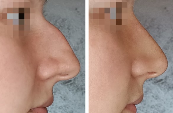 Rhinoplastika zavřenou technikou