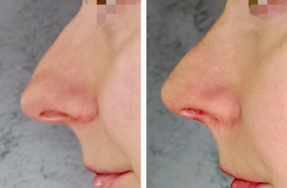 Rhinoplastika otevřenou technikou