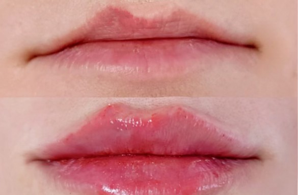 Před a bezprostředně po aplikaci