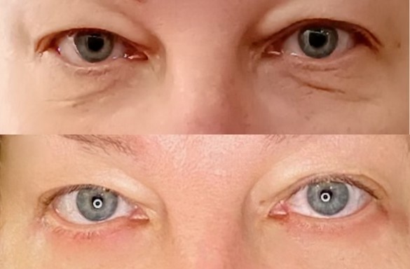 Plastika dolních víček