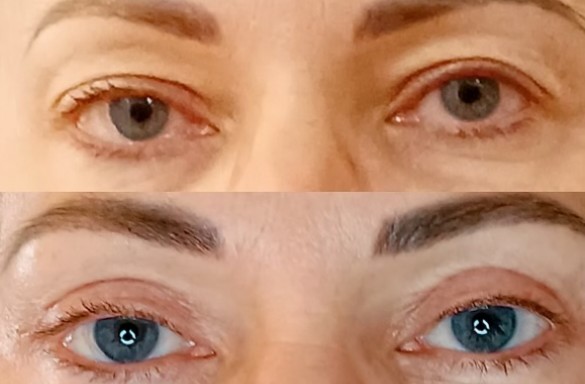 Plastika horních víček