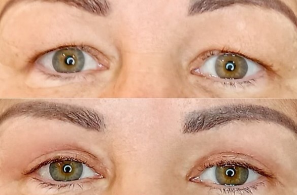 Plastika horních víček