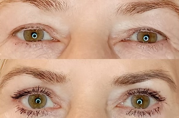 Plastika horních víček