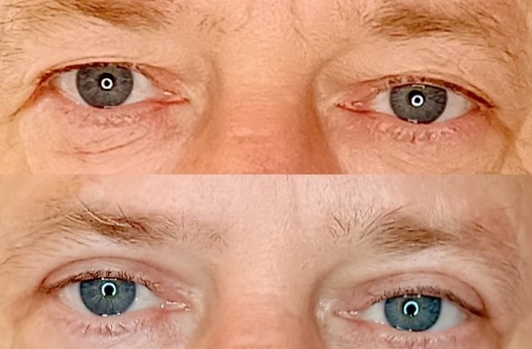 Plastika horních víček