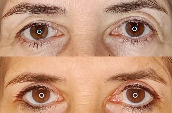 Plastika horních víček