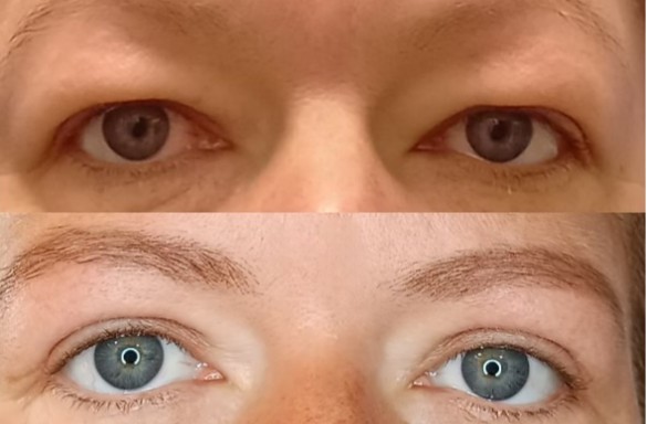 Plastika horních víček