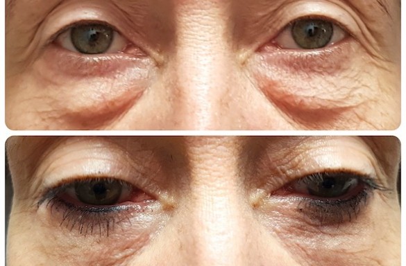 Plastika dolních víček