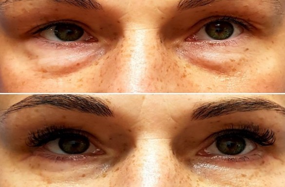 Plastika dolních víček