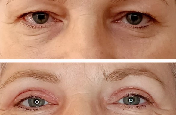 Plastika horních víček