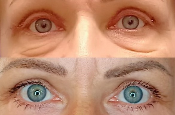 Plastika dolních víček