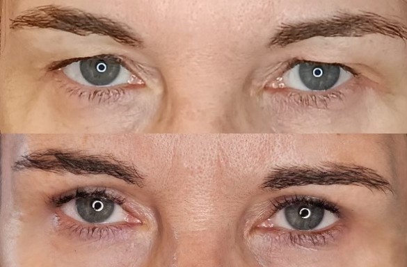 Plastika horních víček