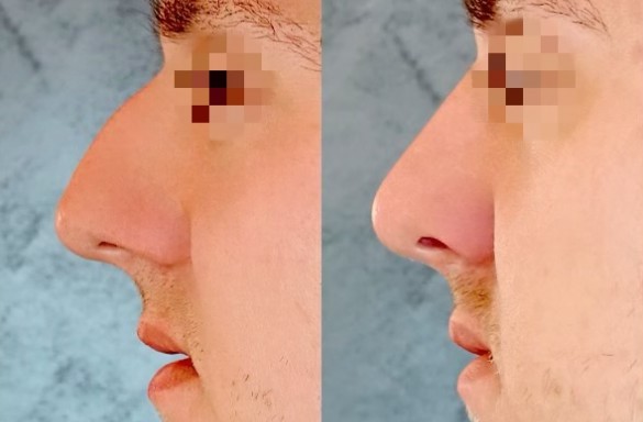 Rhinoplastika zavřenou technikou