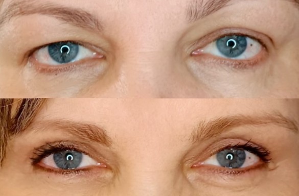 Plastika horních víček