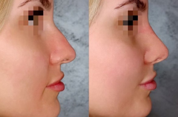 Rhinoplastika zavřenou technikou