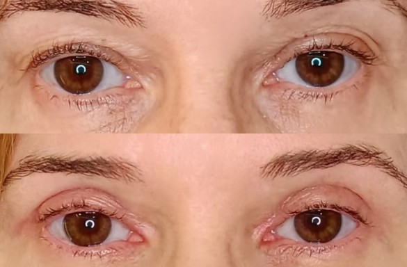 Plastika horních víček