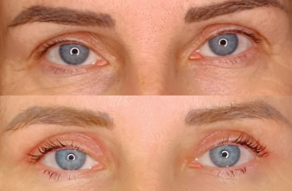 Plastika horních víček