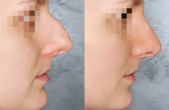 Rhinoplastika zavřenou technikou