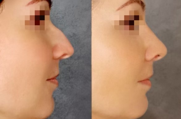 Rhinoplastika zavřenou technikou