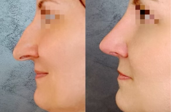 Rhinoplastika otevřenou technikou