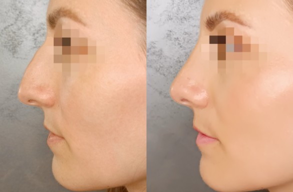 Rhinoplastika zavřenou technikou