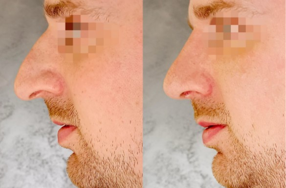 Rhinoplastika zavřenou technikou