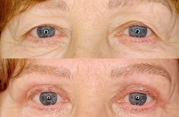 Plastika horních víček