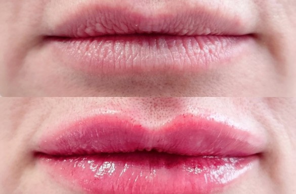 Před a bezprostředně po aplikaci