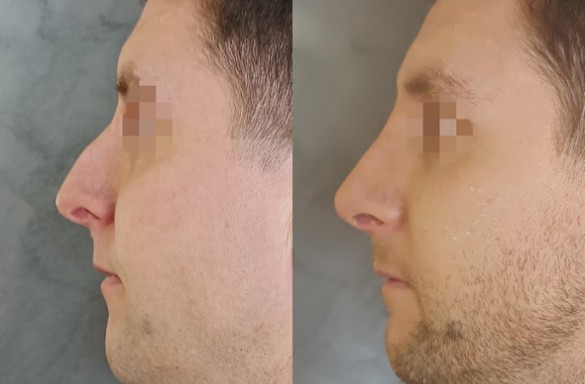Rhinoplastika zavřenou technikou