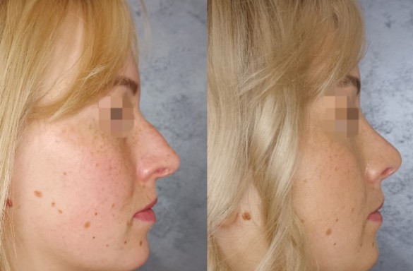Rhinoplastika zavřenou technikou
