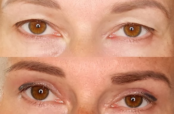 Plastika horních víček