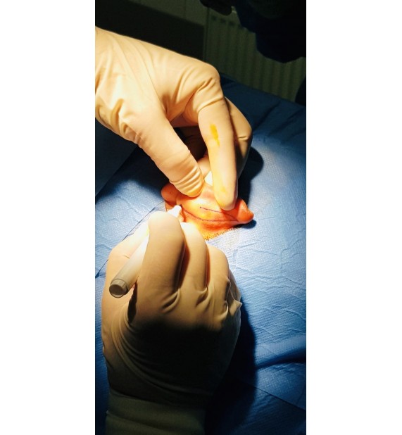 Pečlivý nákres řezu na zadní straně boltce.