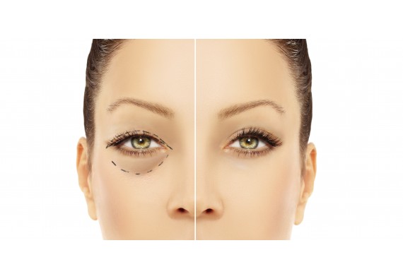 2 specialisté, plastika víček moderním radiofrequenčním skalpelem i klasickou technikou